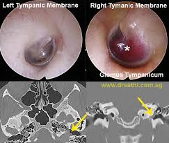 Image result for Tinnitus