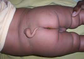 Image result for Spinal Dysraphism