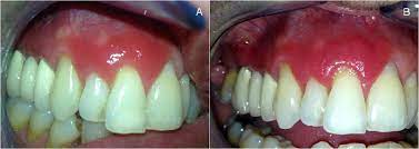 Hypersensitivity Reaction Of The Gingiva To Chlorhexidine Case Report And Literature Review Oral Surgery Oral Medicine Oral Pathology And Oral Radiology