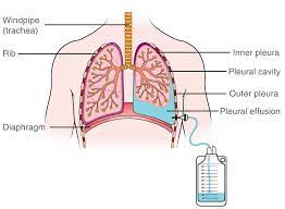Pleural Effusion | Macmillan Cancer Support