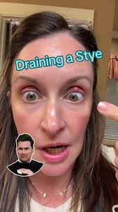 Effective Eye Stye Drainage Method