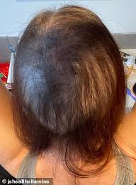 Jshealth vitamins hair + energy formula promotes hair strength, growth and volume + supports energy levels. Civil Servant 34 Who Lost Clumps Of Hair Due To Covid Stress Shares Before And After Snaps From Hair Loss To Hair Growth