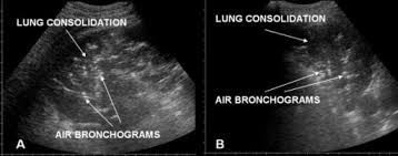 Image result for Air Bronchogram