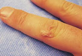 Learn more about hard lumps under the skin here. Pictures Of Bumps On Skin Cysts Skin Tags Lumps And More