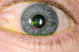 Maybe you would like to learn more about one of these? Herpes Simplex Keratitis Eye Disorders Msd Manual Consumer Version