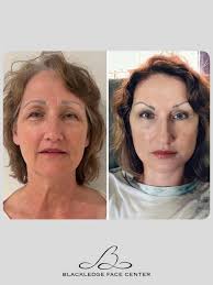 Facelift update with Lori . She's three days post-surgery and still no  bruising. She even went to a party last night and work today. Dr.  Blackledge performed a mini lift