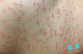 Image result for sweat rash on back