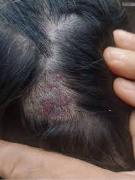 Image result for dry scabs on the head in children