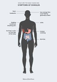 Image result for shingles