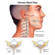 Image result for Neck Pain
