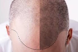 Plant stem cell hair growth. Progress In Stem Cell Treatment For Hair Loss Bioinformant
