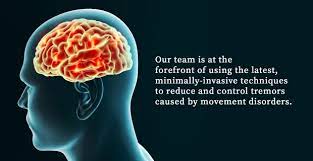 Tremor may occur as a symptom or sign of an underlying disease or as an exaggerated physiological phenomenon. Essential Tremor Neurosurgery Stanford Medicine