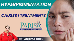 Most Common Causes of Hyperpigmentation