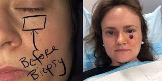 Of course, your specialist is the main person whose advice you should follow but it doesn't do anyone harm. The Pimple Under This Woman S Eye Turned Out To Be Skin Cancer