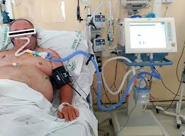 It delivers adequately heated and humidified medical gas at up to 60 l/min of flow and is considered to have a number of physiological effects. Efficacy And Safety Of High Flow Nasal Cannula Oxygen Therapy In Moderate Acute Hypercapnic Respiratory Failure