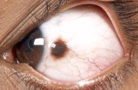 Image result for lesion sclera