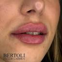 Dr Bertoli - Filler Labbra