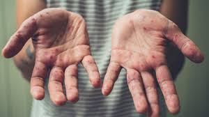 Hand Fuss Mund Krankheit Was Ist Das Uberhaupt