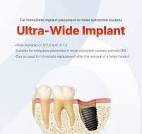 The Ultra-Wide Implant, available in Ø 6.0 and Ø 7.0 is ...