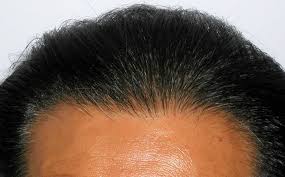 Colors , restore hair health , restore hair conditioner , no brass hair , crimper hair tools. Hairlines Hair Transplant Specialist