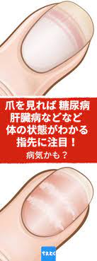 病気かも を示す爪の症状5つ 健康診断 爪 変色 原因 免疫系 糖尿病 変色 白く変色 茶色い 病気 白い筋 バロメーター 糖尿病 トランポリンエクササイズ 免疫系