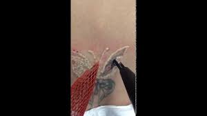 Pain level of tattoo removal. Top Laser Tattoo Removal Center In San Antonio Boerne