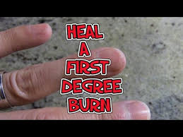 This picture was taken the day after the accident. How To Heal A First Degree Burn Youtube