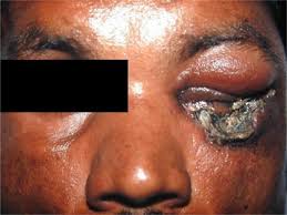 Refers to person, place, thing, quality, etc. Black Eschar Involving The Left Lower Lid With Residual Open I