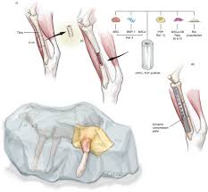 Ar is not available for this model yet. A Preclinical Large Animal Model For The Assessment Of Critical Size Load Bearing Bone Defect Reconstruction Nature Protocols