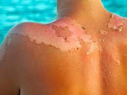 Image result for ‫آفتاب سوختگی‬‎