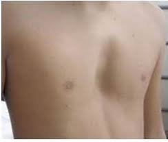 Image result for Pectus Excavatum