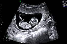 A dating scan is an ultrasound scan to determine ultrasound many weeks pregnant you are and your scan date. 12 Week Scan Nhs