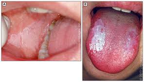 Image result for white cancer on tongue)