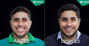 Centro Odontológico Especializado Campoverde Cuando mis pacientes me buscan  por un diseño de sonrisa, lo que me piden son resultados que se vean  naturales, que funcionen sin incomodar y que los dejen