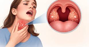 Image result for Tonsillitis