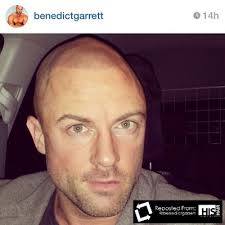 Benedict Garrett has scalp micropigmentation at HIS Hair in London