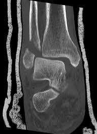 Here's what you need to this can cause permanent damage. Ankle Fracture Wikidoc