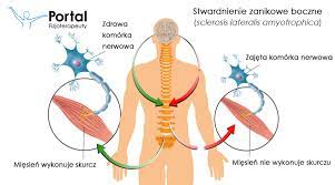W organizmie chorych na sm zniszczeniu ulega mielina, czyli substancja otaczająca włókna nerwowe. Stwardnienie Zanikowe Boczne Portal Fizjoterapeuty