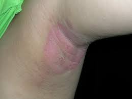 Image result for Erythrasma