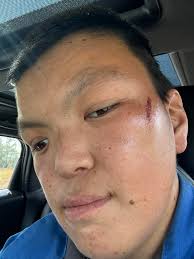 Disc golf accident at nova association