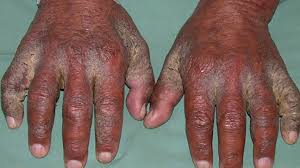 Image result for skin rash similar to scabies