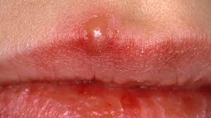 Oral ulcers as a presentation of secondary syphilis. Cold Sores Vs Canker Sores Vs Chancres