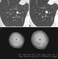 Lung Nodules Size Still Matters European Respiratory Society