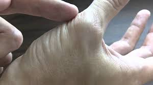 Jun 14, 2021 · the pictures below show what brain lesions may look like on an mri scan. Thumb Muscle Atrophy Carpal Tunnel Syndrome