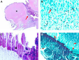 Image result for Broncholithiasis