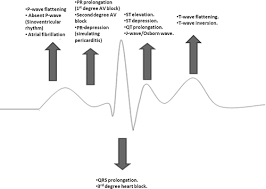 This trail starts from the parking lot 3.5 miles up camel's hump road in duxbury. Electrocardiographic Changes In Hypothermia A Review Therapeutic Hypothermia And Temperature Management