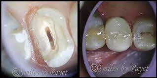 When you need a root canal and crown treatment, it is generally recommended not to just go directly to the least expensive options without careful consideration. Do Teeth With Root Canals Need Crowns