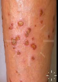 Image result for Varicella zoster on human skin