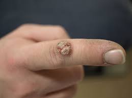 Warzen Hpv Infektion Symptome Therapie Online Hautarzt Appdoc