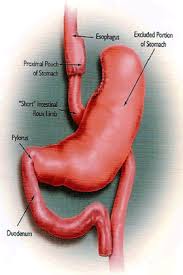 Maybe you would like to learn more about one of these? Gastric Bypass Doctors Syracuse Ny New Hartford William A Graber M D P C